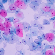 Pap-Test: Zellveränderungen unter dem Mikroskop